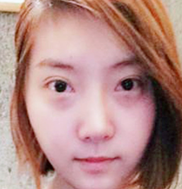 去眼袋手术