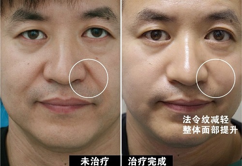 面部提升术