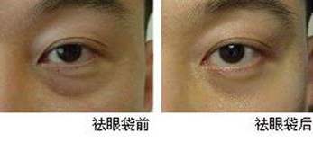 去眼袋手术