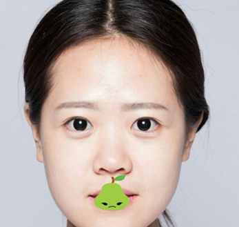 双眼皮手术