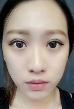 双眼皮手术