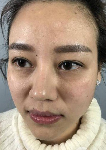 面部提升术