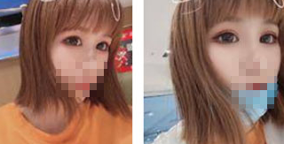 双眼皮手术