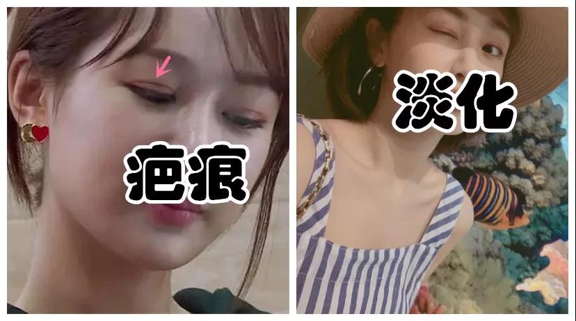 双眼皮手术