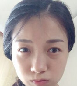 去眼袋手术