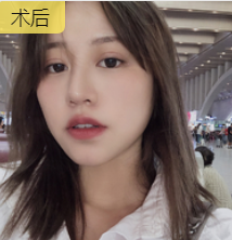面部提升术