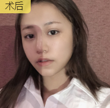 面部提升术