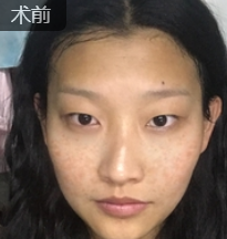 皮秒祛斑