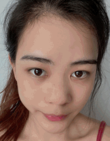 双眼皮手术