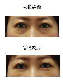 去眼袋手术
