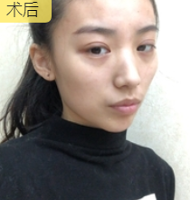双眼皮手术