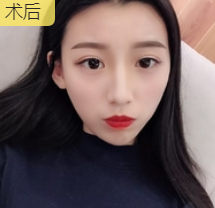 双眼皮手术