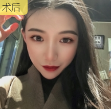 双眼皮手术
