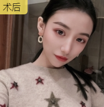 双眼皮手术