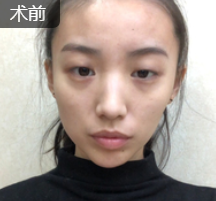 双眼皮手术