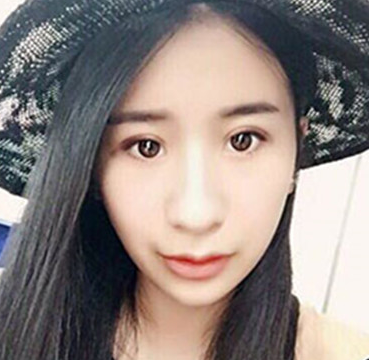 长效玻尿酸