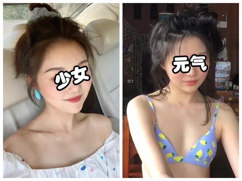 面部提升术