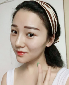 长效玻尿酸