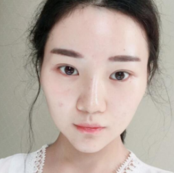 长效玻尿酸
