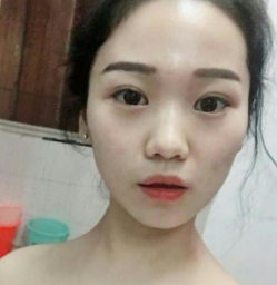 长效玻尿酸