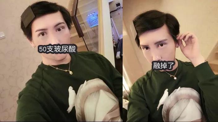 长效玻尿酸