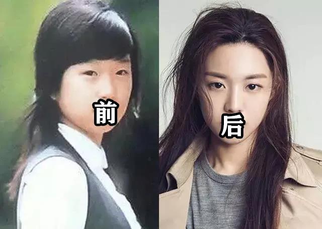 双眼皮手术