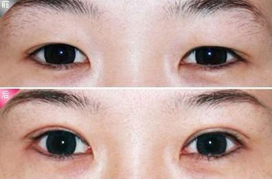 双眼皮手术