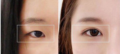 双眼皮手术