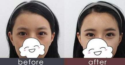 长效玻尿酸