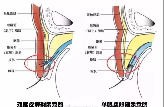 双眼皮手术