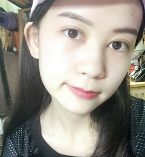 双眼皮手术