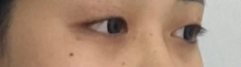双眼皮手术