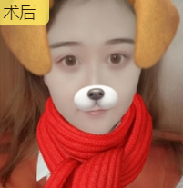 去眼袋手术