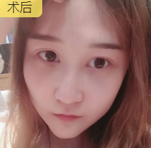 去眼袋手术