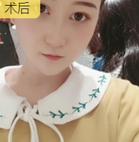 去眼袋手术