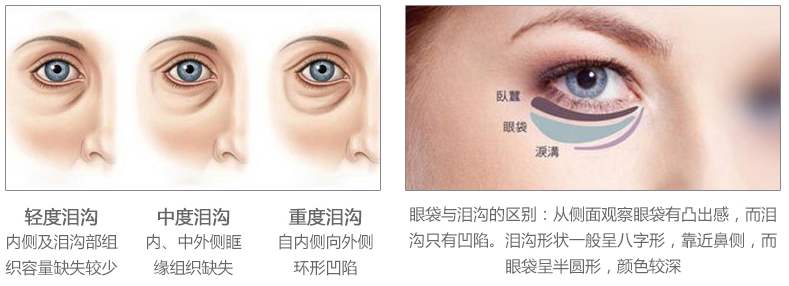 去眼袋手术
