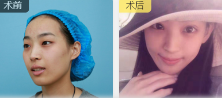 双眼皮手术