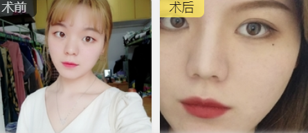 双眼皮手术