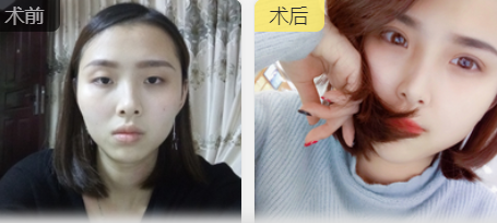 双眼皮手术