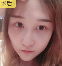 去眼袋手术