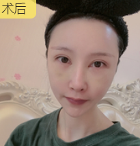 去眼袋手术
