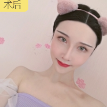 去眼袋手术