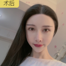 去眼袋手术