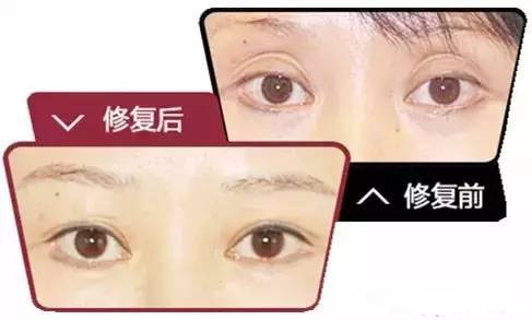 长效玻尿酸