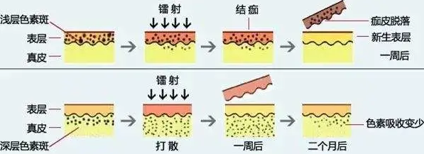皮秒祛斑