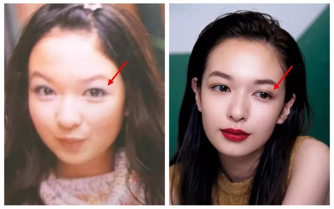 双眼皮手术