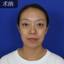 去眼袋手术