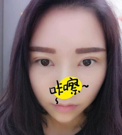 双眼皮手术