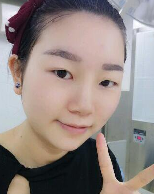 双眼皮手术