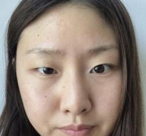 双眼皮手术